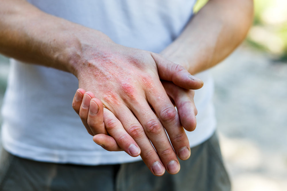 Stop Eczema Flare-Ups After Workouts