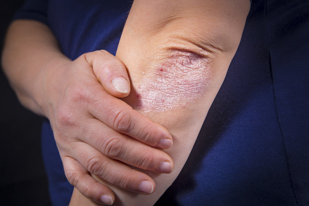 Exercise With Psoriasis? Yes You Can!