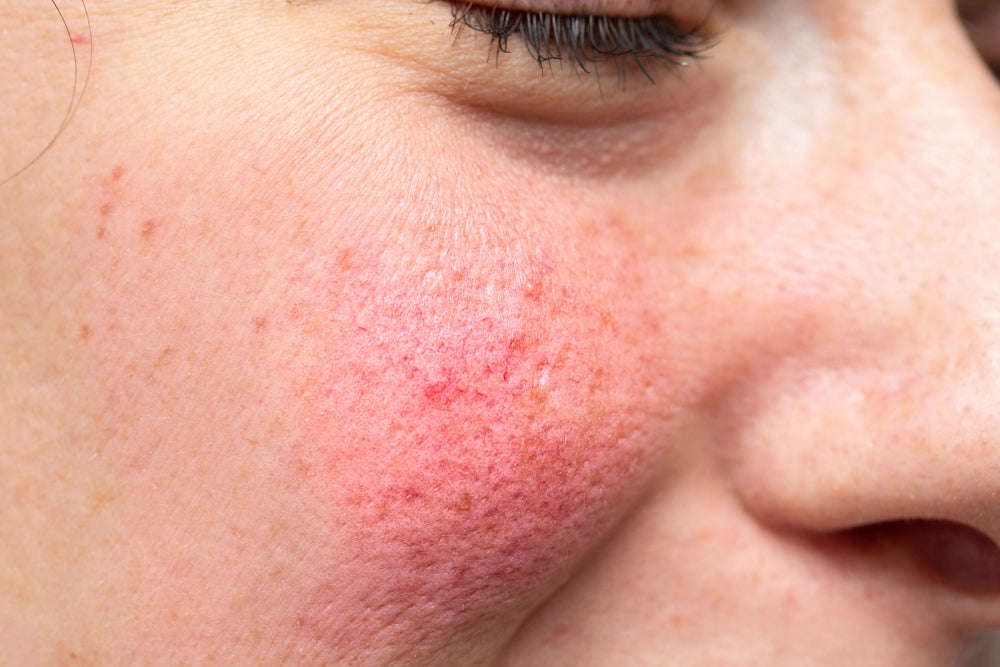 Exercising With Rosacea